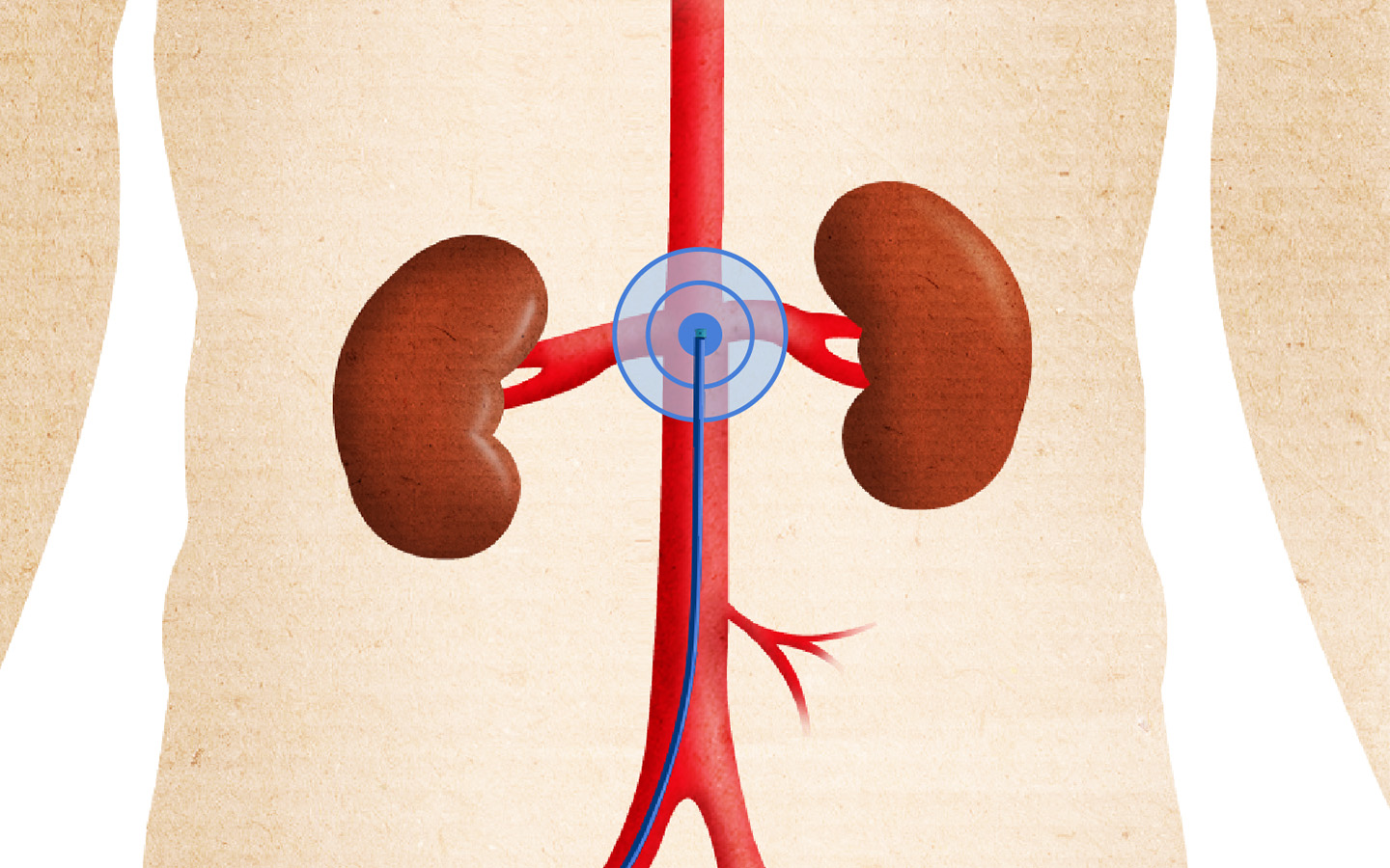 Kidney 01