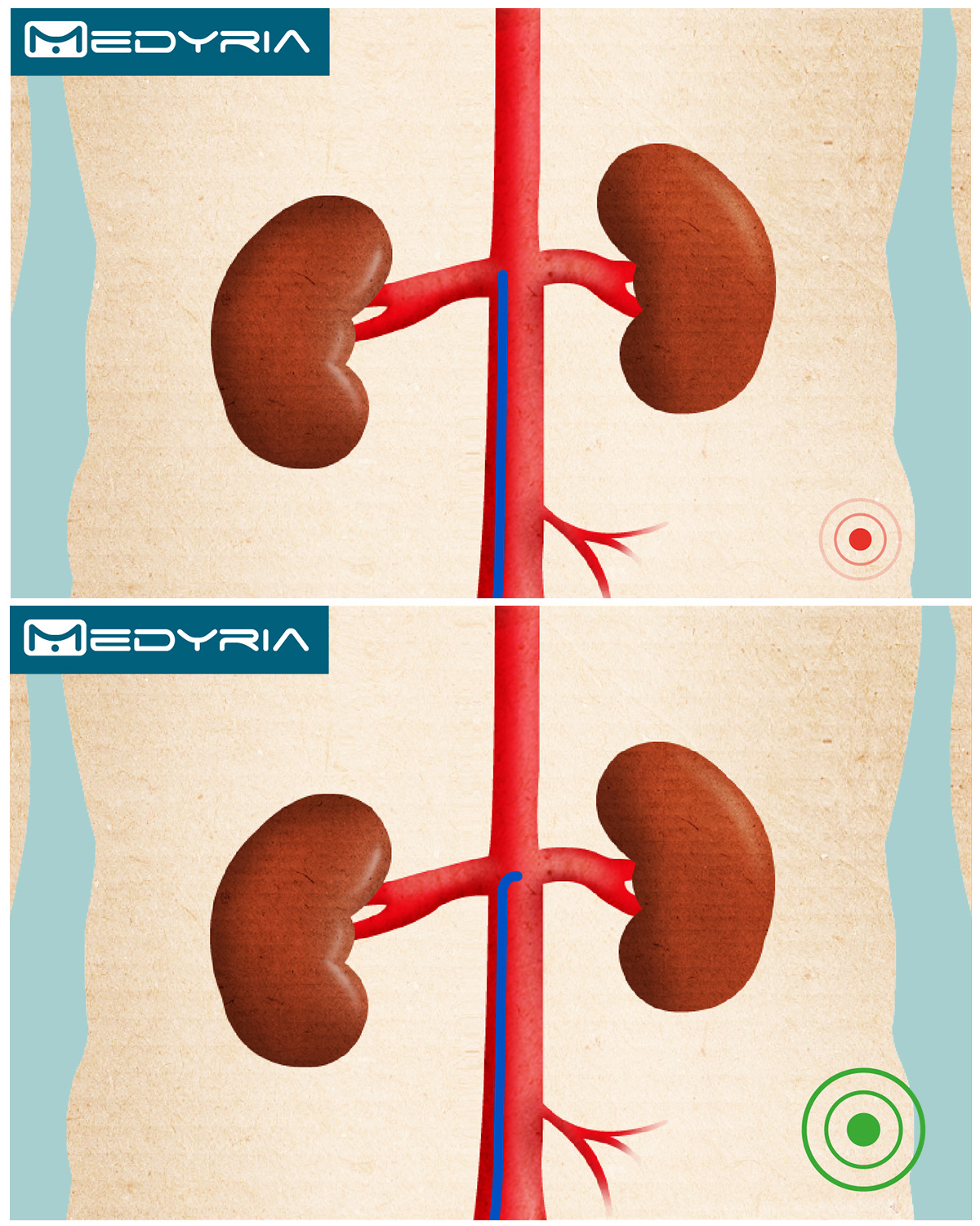 Kidney 03